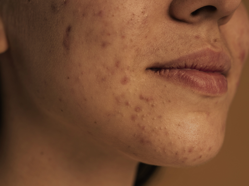 Primer plano de rostro con acné antes del tratamiento dermatológico